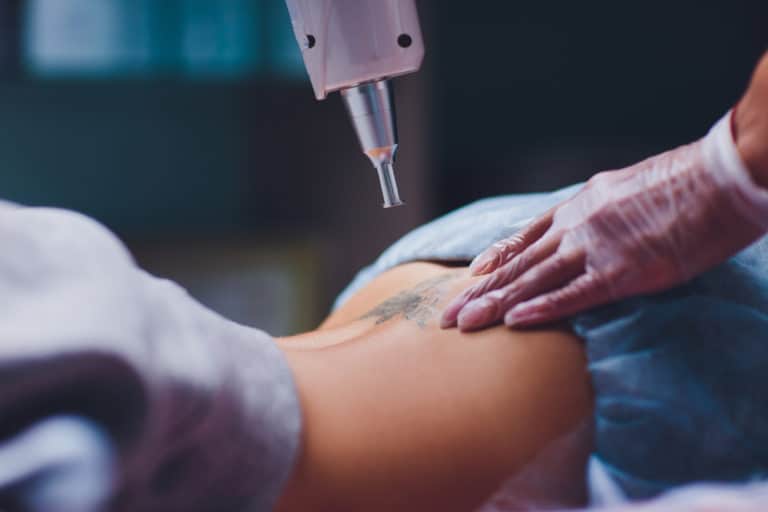 How Long Does Tattoo Removal Take To Heal?