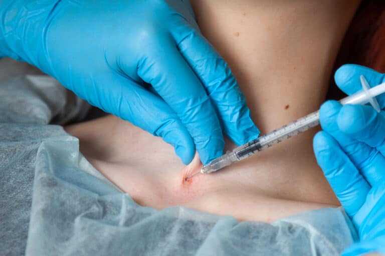 How To Remove A Rejecting Dermal Piercing